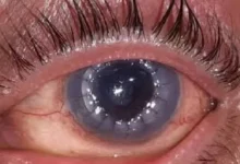 सिम्स में नेत्रदान से मिली रोशनी सिम्स में हुआ कॉर्निया प्रत्यारोपण का सफल ऑपरेशन