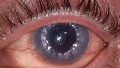 सिम्स में नेत्रदान से मिली रोशनी सिम्स में हुआ कॉर्निया प्रत्यारोपण का सफल ऑपरेशन