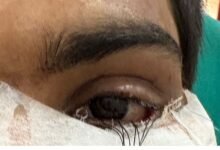 स्किन ग्राफ्टिंग से मरीज के पलक का सफल पुनर्निर्माण,,,,,