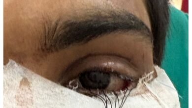 स्किन ग्राफ्टिंग से मरीज के पलक का सफल पुनर्निर्माण,,,,,