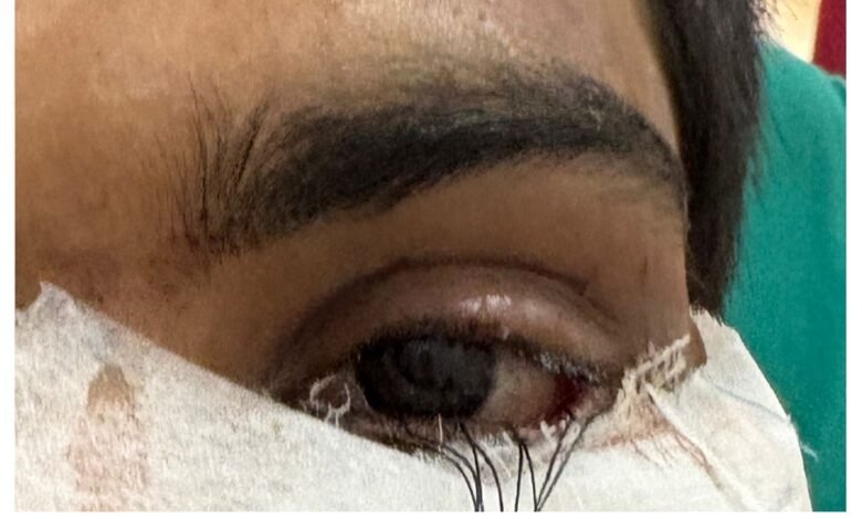 स्किन ग्राफ्टिंग से मरीज के पलक का सफल पुनर्निर्माण,,,,,