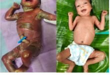 सुदूर बीजापुर में चिकित्सा चमत्कार : अत्यंत दुर्लभ बीमारी से जूझते शिशु को बचाया