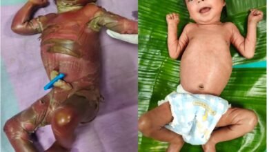 सुदूर बीजापुर में चिकित्सा चमत्कार : अत्यंत दुर्लभ बीमारी से जूझते शिशु को बचाया
