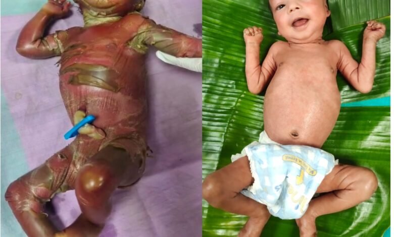 सुदूर बीजापुर में चिकित्सा चमत्कार : अत्यंत दुर्लभ बीमारी से जूझते शिशु को बचाया