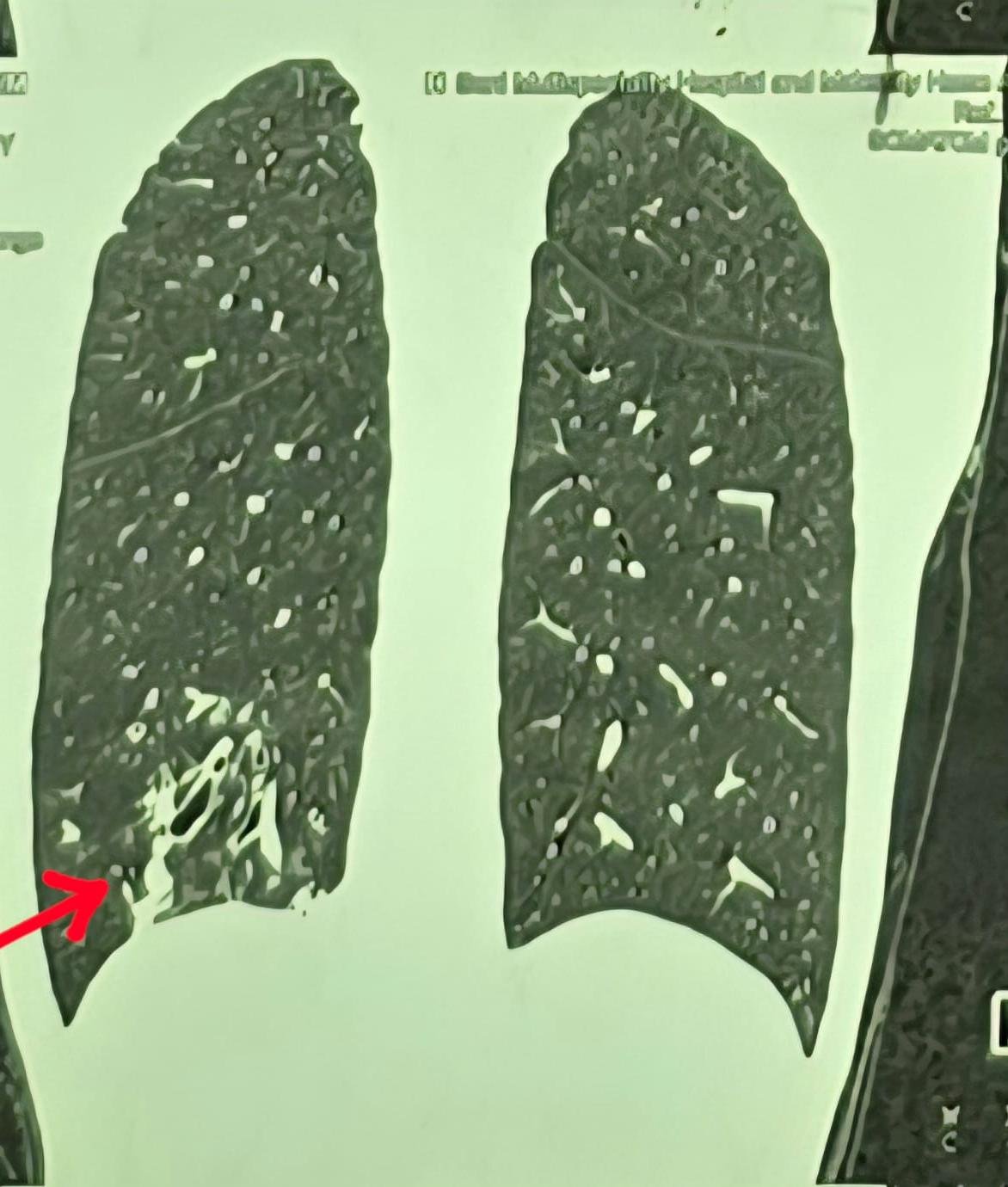 10 साल से खाँसी में खून की समस्या झेल रहे युवक को अम्बेडकर अस्पताल में मिली नई जिंदगी
