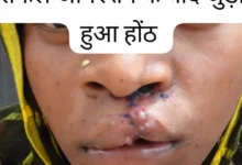 सफल सर्जरी से भीमे हेमला के चेहरे पर लौटी मुस्कान, जन्मजात होंठ की विकृति का हुआ सफल उपचार