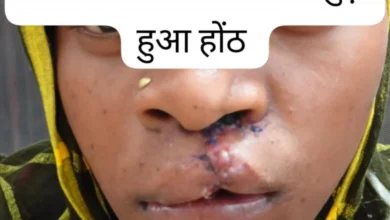 सफल सर्जरी से भीमे हेमला के चेहरे पर लौटी मुस्कान, जन्मजात होंठ की विकृति का हुआ सफल उपचार