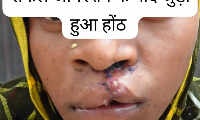 सफल सर्जरी से भीमे हेमला के चेहरे पर लौटी मुस्कान, जन्मजात होंठ की विकृति का हुआ सफल उपचार सफल सर्जरी से भीमे हेमला के चेहरे पर लौटी मुस्कान, जन्मजात होंठ की विकृति का हुआ सफल उपचार
