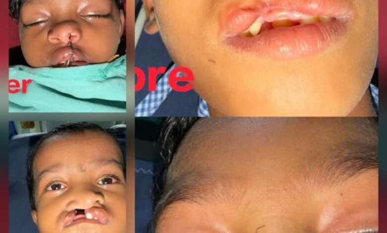 बीजापुर के दूरस्थ गांवों से अयान, अंजलि और सविता का रायपुर में हुआ उपचार बीजापुर के दूरस्थ गांवों से अयान, अंजलि और सविता का रायपुर में हुआ उपचार